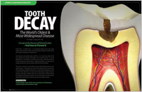 Tooth Decay Prevention - Dear Doctor Magazine